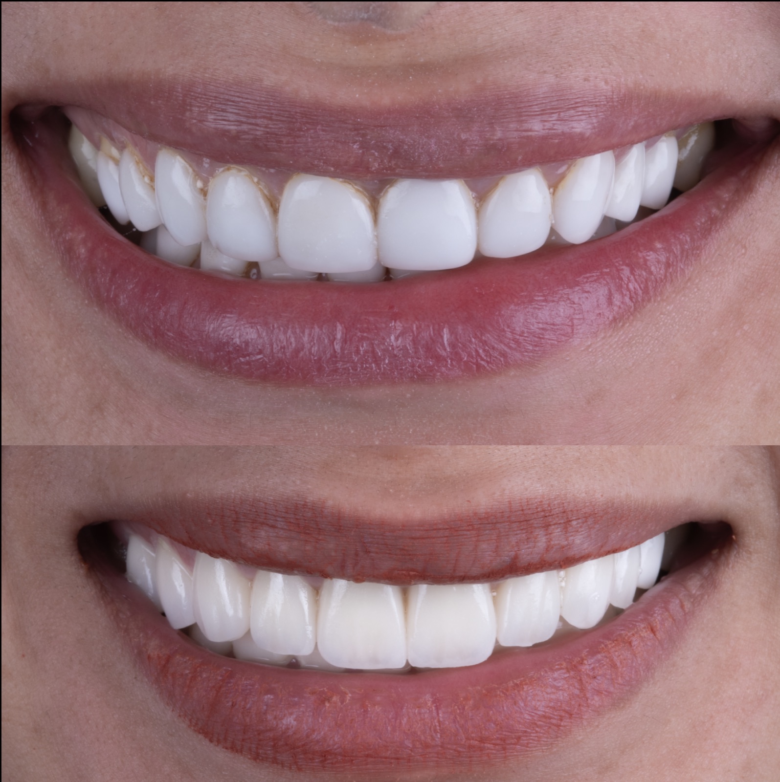 Comparison of E.max and feldspathic porcelain veneers on the same patient by Dr. Faysal Succaria