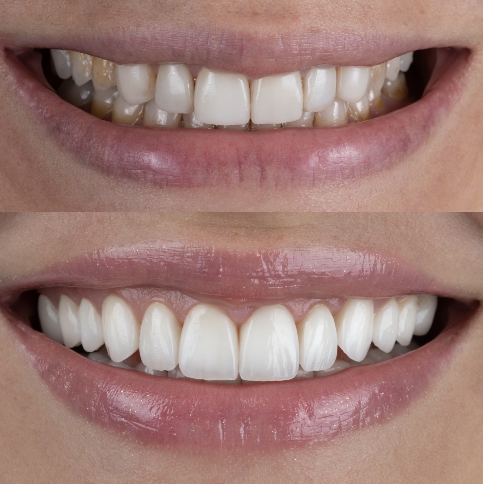 Before and after: a worn, stained upper arch rebuilt by Dr. Faysal Succaria — full-mouth rehabilitation case