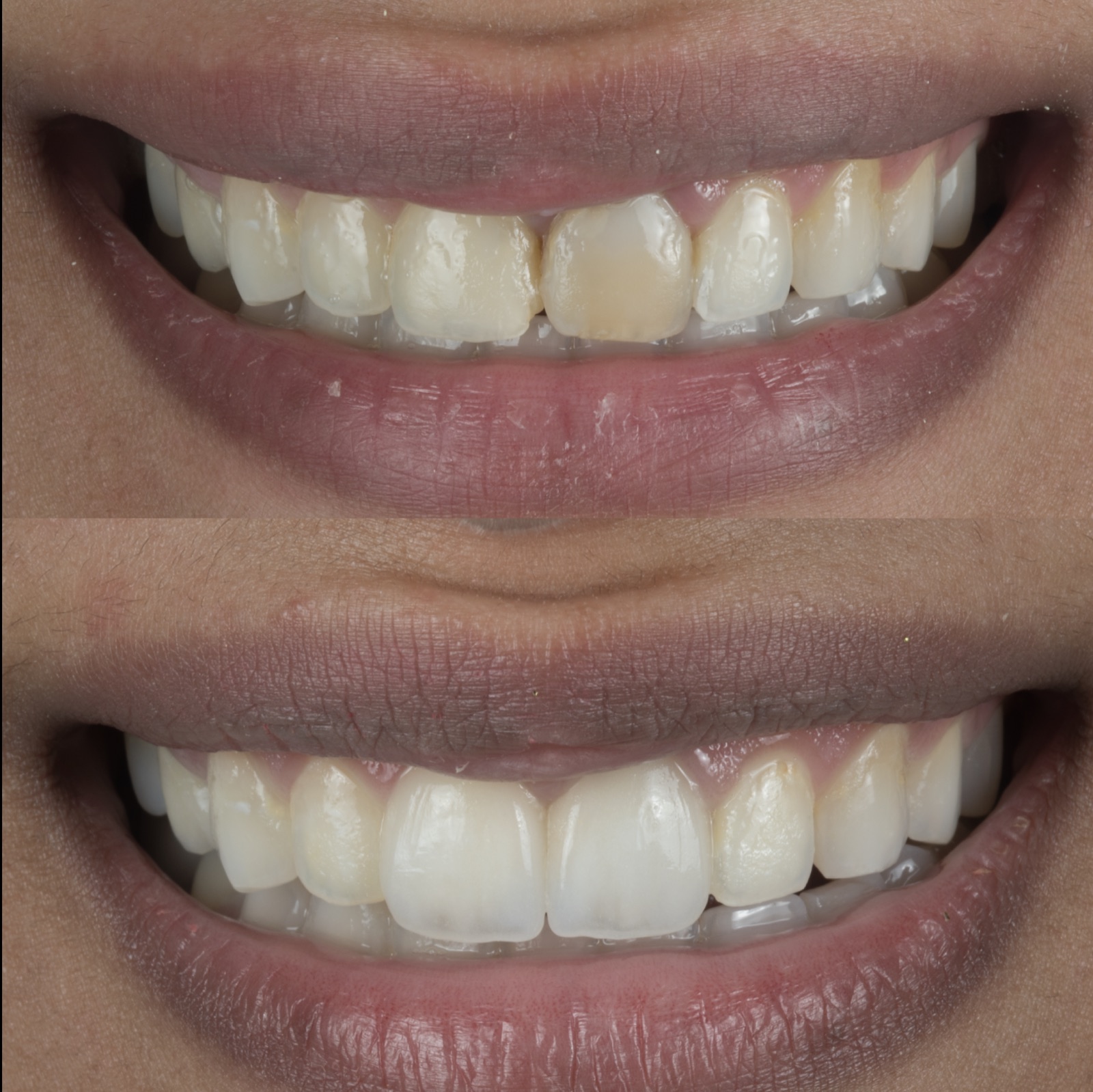 Before and after: a discolored front tooth corrected with a natural-looking ceramic veneer by Dr. Faysal Succaria
