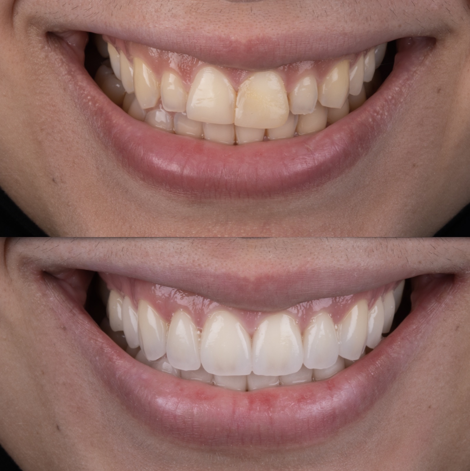 Before and after: discolored, uneven front teeth restored with natural ceramic veneers by Dr. Faysal Succaria