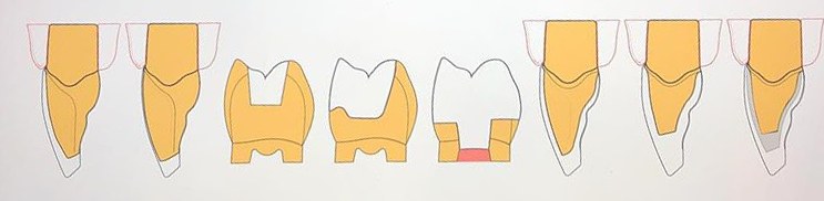 Clinical illustration of veneer and crown preparation designs, from minimal partial coverage to full coverage
